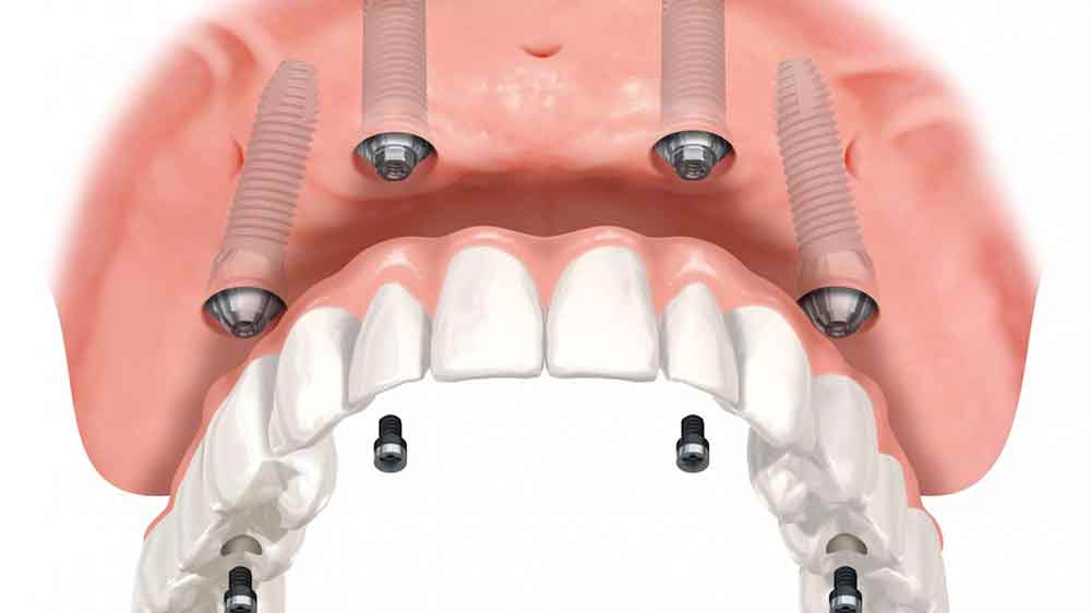 Протезирование зубов: особенности процедуры, используемые материалы