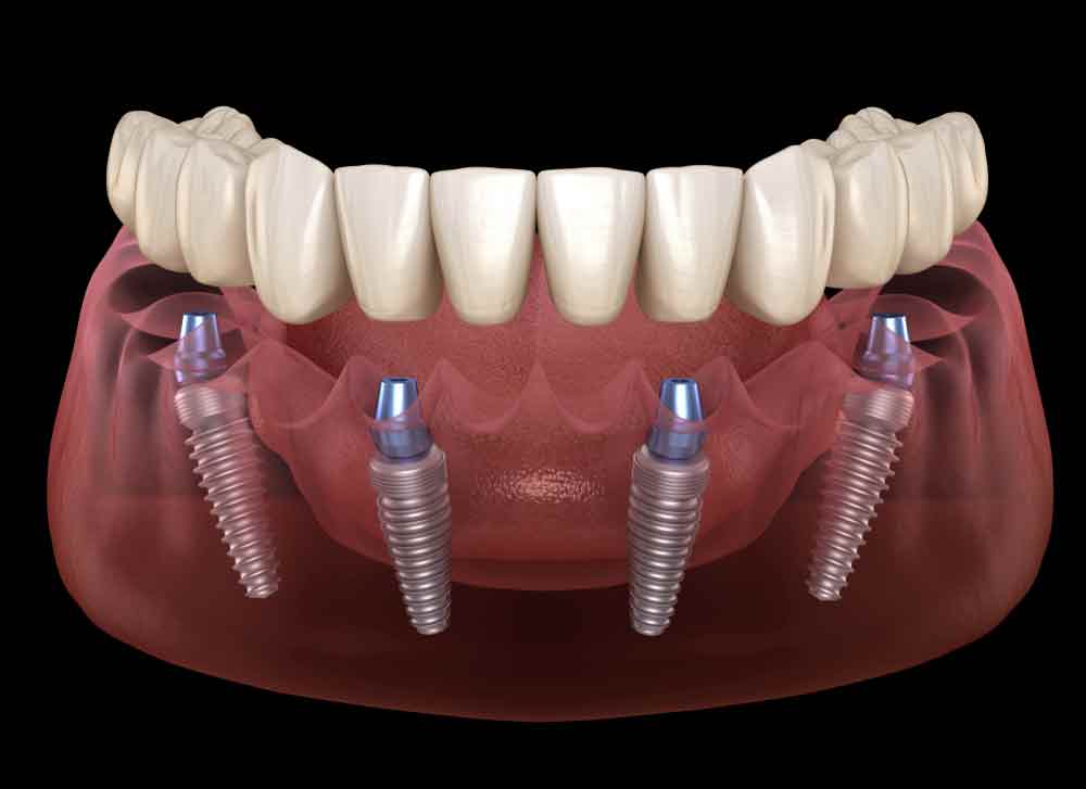 Какую технологию имплантации зубов выбрать