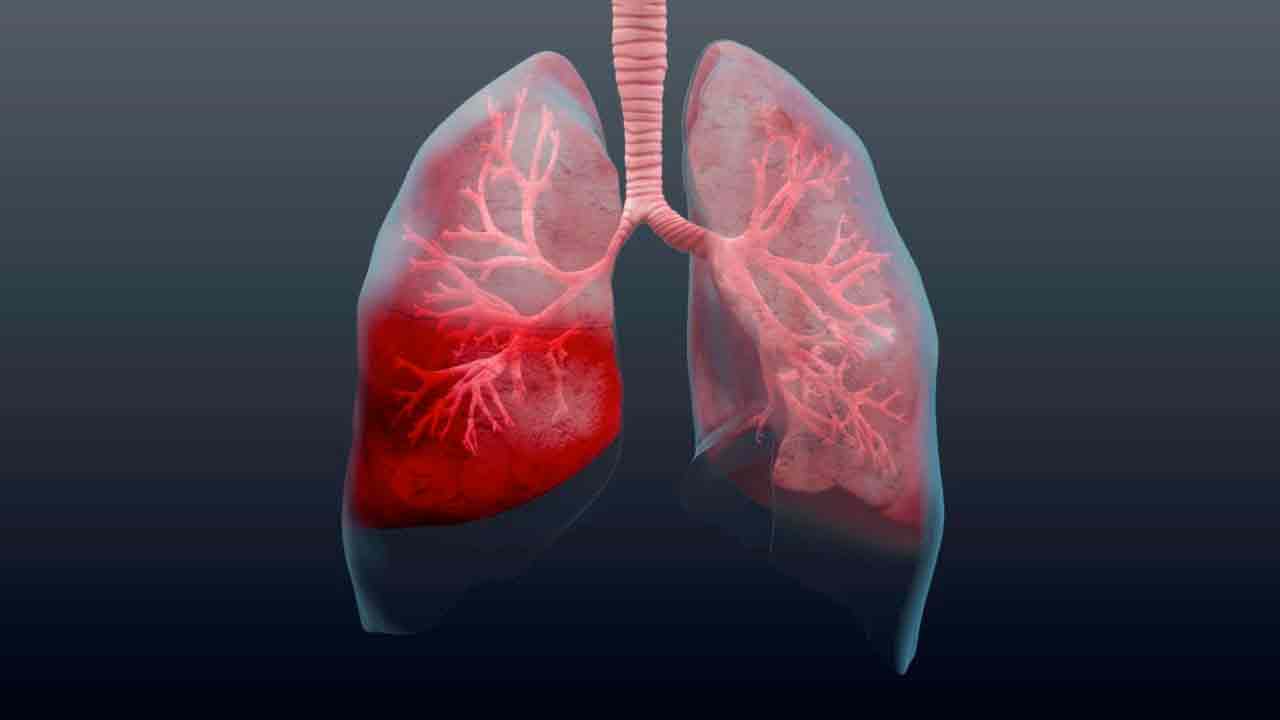 Что такое пневмония и как ее диагностировать?